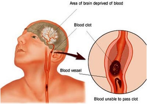 Các dấu hiệu phát hiện sớm đột quỵ nhồi máu não