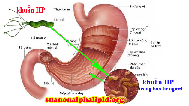 Viêm loét dạ dày tá tràng và vi khuẩn HP