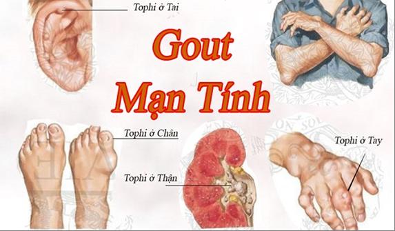 Bệnh gút - một số yếu tố nguy cơ - cách phòng ngừa  