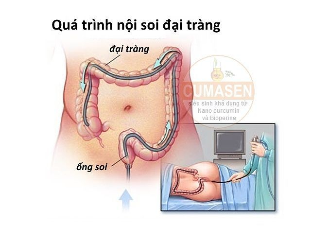 Những điều cần biết về nội soi đại tràng