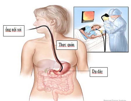 Những điều cần biết về nội soi đường tiêu hóa trên 