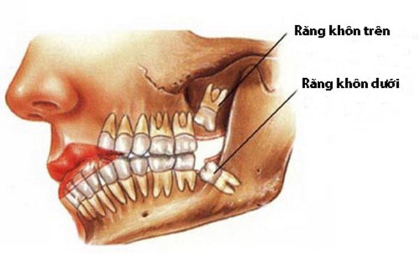 Biến chứng mọc răng số 8