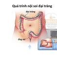 Những điều cần biết về nội soi đại tràng